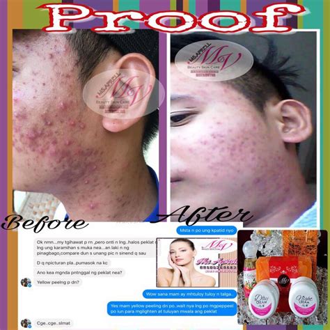 hanap nyo sabon pampatanggal Ng acne at dry skin, ito na mga .